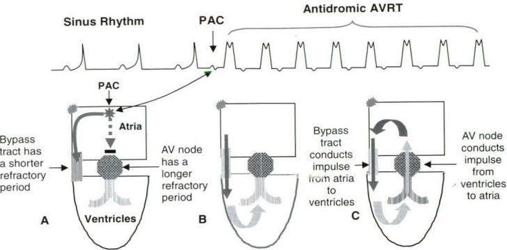 avrt antidr approach-to-a-case-of-narrow-complex-tachycardia-34-728